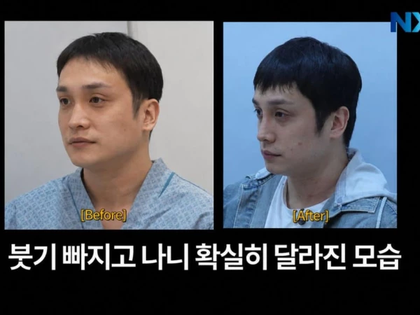 Ринопластика кардинально изменила внешность Ким Тэ Хона из ZE:A: «Face ID меня не узнаёт»