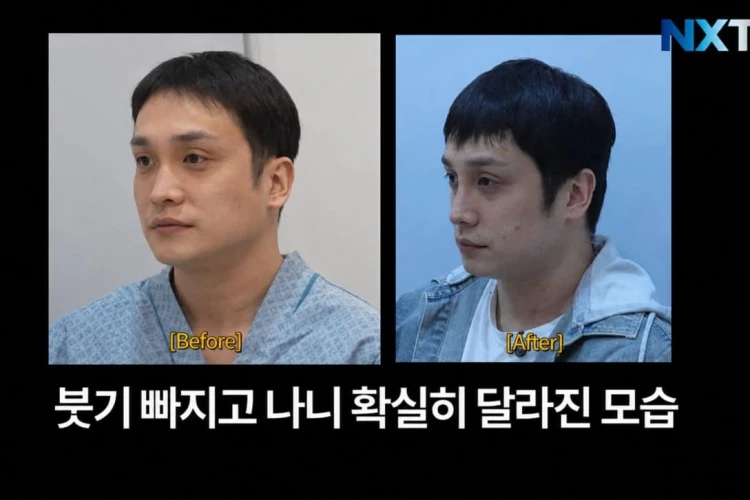 Ринопластика кардинально изменила внешность Ким Тэ Хона из ZE:A: «Face ID меня не узнаёт»